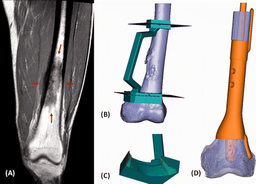 Figure 6. (A) A coronal T1-weighted MR image of a patient with a low-grade osteosarcoma of the left femur (red arrows). (B) CT images of the femur were imported into the CAD software. The surgeon defined the proximal and distal bone resections that determined the design of a CAD/CAM surgical jig. (C) The matching contour surface at the distal resection site (the green region represents the actual bone contact area). (D) A custom CAD intercalary prosthesis was designed to match exactly the bone defect after resection. Extracortical plates were added to improve the initial stability of fixation for the reconstruction.