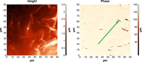 Figure 4 Fragment of an atherosclerotic plaque of mixed composition.Notes: AFM (left), MFM (right). MFM shows BMNPs in the form of dark spots arranged in chains (arrow). There were no bacteria-like magnetosome BMNPs, but alignment of the BMNPs is visible along the plaque surface. Samples of atherosclerotic vessels were extracted from iliac artery during shunting surgery.Abbreviations: AFM, atomic force microscopy; MFM, magnetic force microscopy; BMNPs, biogenic magnetic nanoparticles.