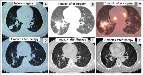 Figure 1. Response of sorafenib combined with sirolimus for metastatic PEComa in the lungs (A) CT demonstrated a mass in the right lung before surgery. (B, C) PET-CT showed pulmonary metastases one month after surgery. (D-F) CT showed complete response of pulmonary metastases after combination therapy.