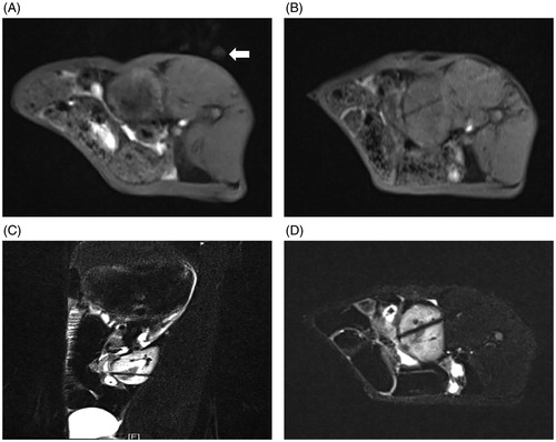 Figure 2. MR-guided puncture of renal tumors. (A) Preoperative surface localization by a vitamin E capsule (white arrow). (B) The 3D-VIBE-T1WI axial scan revealed that the needle antenna was punctured into the kidney, but its relationship with the lesion could not be distinguished. FS-TSE-T2WI oblique-coronal (C) and oblique-axial (D) scans obviously indicated that the needle antenna was positioned within the renal tumor.