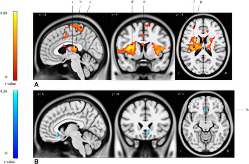 Figure 2 Brain regions (de-)activated during the modified cold pressor test. Two contrasts were analysed: [Pain >Control] and [Control>Pain]. (A) Activations; [Pain>Control] contrast. (B) De-activations; [Control>Pain] contrast.Abbreviations: a, L-caudate nucleus; b, L/R-thalamus; c, L-paracentral lobule; d, L/R-insula; e, L-precuneus; f, L-putamen; g, L-middle frontal gyrus; h, R-medial orbital.