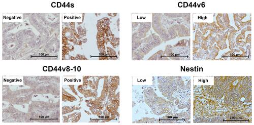 Figure 1 Representative IHC staining of CD44s, CD44v6, CD44v8-10 and Nestin in human CCA tissues (magnification 20X).
