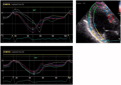 Figure 2. Example of strain curves from the apical long-axis view, from a patient with an occluded left circumflex artery at baseline. Substantial post-systolic shortening is observed in the basal- and mid-inferolateral segments (yellow and cyan traces). After successful revascularization, normal systolic function is observed in the same segments at follow-up. With permission from: Eek et al.[Citation23]
