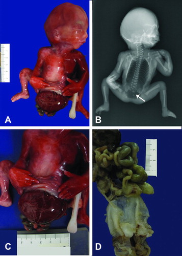 Figure 5.  (A) Gross photograph of fetus with no external genitalia and omphalocele sac involving abdomen and pelvis. Notice flexion deformity of both lower extremities. (B) Post-mortem antero-posterior x-ray showing a large lucency occupuing the chest and abdomen consistent with post-mortem air, there are vertebral body segmentation anomalies and hypoplastic sacrum (arrow). (C) Photograph depicts a closer view of extracorporeal organs. (D) Gross picture of formalin fixed organ block of Patient 4. The lower portion demonstrates the omphalocele sac still attached to abdomino-pelvic organs.