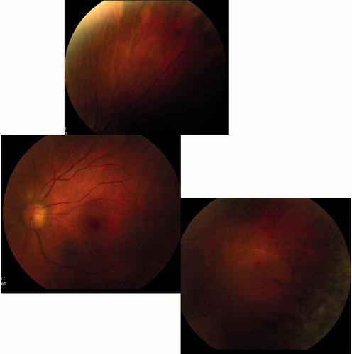 Figure 1. Fundus montage demonstrating occluded retinal arterioles and retinitis.