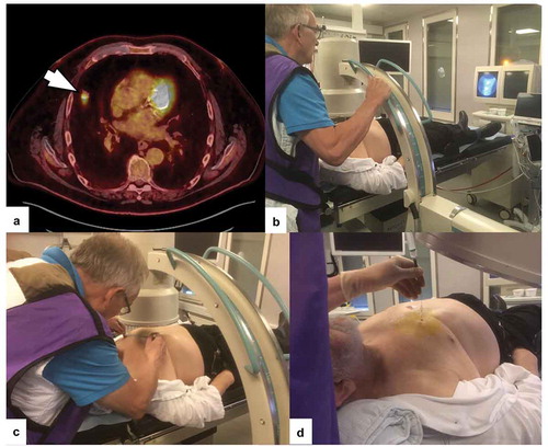 Figure 1. a) PET-CT showing a peripheral solid lesion in the anterior part of right upper lobe without pleural contact or bronchus sign (arrow). (b) With the patient in supine position, the operator locates the lesion in the anterior-posterior (A-P) projection with the C-arm with on-time fluoroscopic images on the screen.. (c) The borders of the lesion are marked on the skin with a filt pen and a metallic ruler. (d) Fine-needle aspiration with a Chiba needle via a guiding needle. The position of the needle tip can be checked with the C-arm in any angle different from the A-P-projection