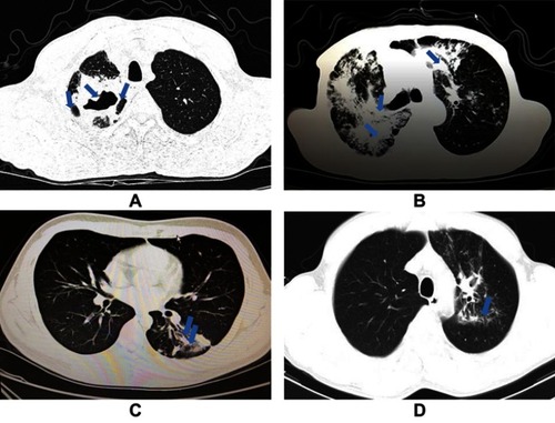Figure 1 Imaging signs of transvers CT scans from patients in the drug-sensitive tuberculosis (DS-TB) group and multidrug-resistant tuberculosis (MDR-TB) group. (A) Lung window of chest CT scan from a patient in the MDR-TB group in the present study, showing multiple large cavities (arrows), mainly in the left upper lobe, with lung volume loss. (B) Lung window of chest CT scan from another patient in the MDR-TB group in the present study, showing extensive cavitary lesions (arrows) evolved in the bilateral lungs. (C) Lung window of chest CT scan from a patient in the DS-TB group in the present study, showing at the level of the left basal trunk small nodules branching in the linear and lobular area of bronchiectasis (arrows), with a single cavity formation in the left lower lobe. (D) Lung window of chest CT scan from another patient in the DS-TB group in the present study, showing at the level of the aortic arch nodular opacities and consolidations (arrow), and the lobular area of infiltration lesions.