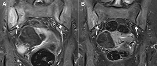 Figure 2 MRI findings of the sacroiliac joints before and two months after the introduction of ustekinumab. (A) STIR-MRI image presents hyperintense foci in the bilateral sacroiliac joints, especially on the right side (arrows). (B) STIR-MRI image shows mild enhancement on the right side only (arrows). MRI-STIR, Short tau inversion recovery-magnetic resonance imaging.