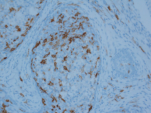 Figure 8 CD1a positive staining of many intralobular dendritic cells. (Magnification ×200).