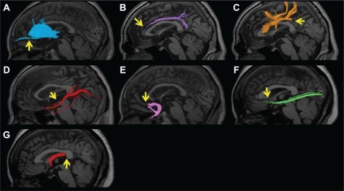 Figure 3 An example of poor depiction of the nerve fascicles superimposed on T1-weighted sagittal images. (A) Anterior thalamic radiation. Only a few nerve fascicles were depicted in the region beyond the genu of the corpus callosum (arrow). (B) Cingulate fasciculus. No nerve fascicle was depicted in the anterior upper region of the corpus callosum (arrow). (C) Superior longitudinal fasciculus. The region from the parietal to temporal lobe was not depicted (arrow). (D) Inferior longitudinal fasciculus. Only a few nerve fascicles were depicted (arrow). (E) Uncinate fasciculus. The nerve fascicle extending to the orbitofrontal cortex was not depicted (arrow). (F) Inferior fronto-occipital fasciculus. Very few nerve fascicles were noted, and no nerve fiber extending to the prefrontal area was depicted (arrow). (G) Fornix. The crus was not depicted (arrow).