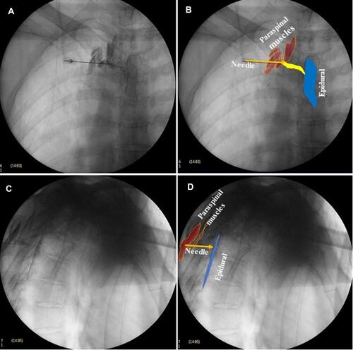 Figure 5 Delineation of the radiopaque agent in the epidural space under fluoroscopy. (A) The AP view on fluoroscopy showed that the epidural space within the pedicle was evenly delineated. (B) Schematic diagram of the delineation in the AP view on fluoroscopy. The blue area is the epidural space, the yellow area is the nerve, and the brown area is the paravertebral muscle. (C) The lateral view of fluoroscopy showed smooth circular arc staining at the posterior edge of the intervertebral foramen. (D) Schematic diagram of the delineation in lateral view on fluoroscopy. The blue area is the epidural space and the brown area is the paravertebral muscle.