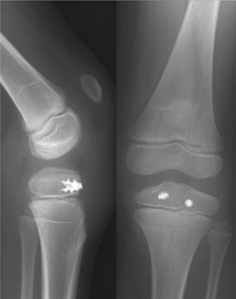 Figure 3. The left knee 1½ years after the operation.