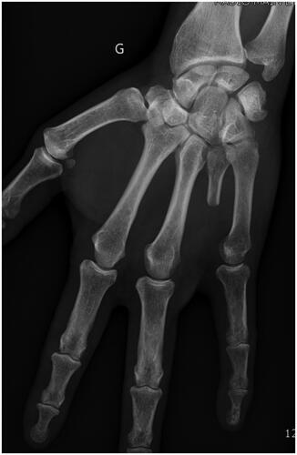 Figure 2. Plain AP view of the hand after amputation of the fourth ray, as per the modified Le Viet technique. G Left side (in French: Gauche).