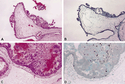 Figure 2. Partial mole at 10 × lens (A and B) and 20 × lens (C and D) show the hematoxylin and eosin stain (A and C) and focal positivity for p57 (B and D) in the cytotrophoblast but not the mesenchyme. The intermediate trophoblast is focally positive.