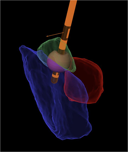 Figure 3 Deep brain stimulation (DBS). DBS simulation with electrode in Orange, red nucleus in red, substantia nigra in blue and subthalamic nucleus in green. The electrical field is depicted as a small purple sphere around the electrode and within the subthalamic nucleus. Several parameters of the electrical field can be adjusted, such as its shape, voltage, pulse width, and frequency, to tailor its influence on the surrounding anatomy, maximizing beneficial effects and minimizing side effects. (Figure courtesy of Dr Marie Krueger).