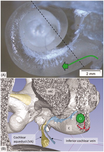 Figure 3. (A) Plastic corrosion cast of a left human cochlea. Radiating arterioles of the basal turn of the cochlea can be observed. The route for electrode insertion at the CI is shown in green at arrow. (B) Micro-CT and 3D rendering of a plastic mold from a left human temporal bone (medial view). The level of cropping is shown (interrupted line). The inferior cochlear vein channel is seen (blue), as well as the cochlear aqueduct. The vein drains blood from the cochlea and runs parallel to the cochlear aqueduct. C: cochlea; CI: cochlear implantation; IAC: internal acoustic canal.