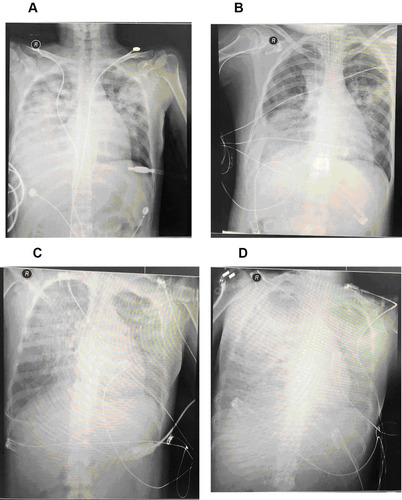 Figure 2 Chest X-ray of a 36-year-old pregnant female patient with C. psittaci pneumonia and died of septic shock, DIC, and multiple organ failure. (A) on the first day of hospitalization, (B) on the third day of hospitalization, (C) on the sixth day of hospitalization, (D) on the seventh day of hospitalization.