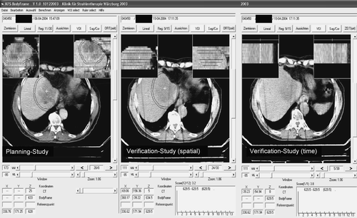 Figure 1.  CT-verification on the treatment couch using in-house software. The planning study and the verification study are matched using the fixed stereotactic system represented by fiducials in the body frames sidewalls. The isocenter coordinate is automatically placed at the planned position and can be moved by mouse click from the planned to the appropriate position in the verification study. The new coordinate is shown in the bottom window. The structure set of the planning study (CTV, PTV, liver contour etc.) are related to the isocenter coordinate and can be moved with the isocenter to the most appropriate position. Because the verification study (spatial) is just a slice-by-slice scan the isocenter correction might be performed in a random position of the breathing cycle. Therefore a second (time) study is performed scanning 15 s continuously at the chosen longitudinal couch position. During that time the influence of breathing mobility can be evaluated. In the shown case no correction is necessary: in the two small reconstructions at top of the right window a sagittal and coronal view are shown. The 15 slices are representing the 15 s breathing scan at a position marked by a radioopaque clip from a former liver resection. The clip is not moving to the left or right nor to the anterior-posterior direction indicating no relevant breathing mobility of the target.