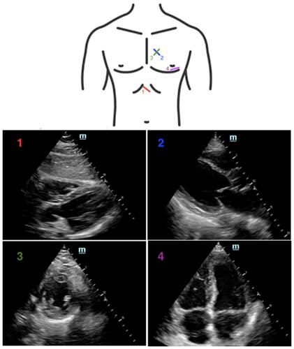 Figure 1 Location on the chest where the (1) subxiphoid, (2) parasternal long axis, (3) parasternal short axis, and (4) apical 4-chamber views are obtained, with corresponding sonographic images.