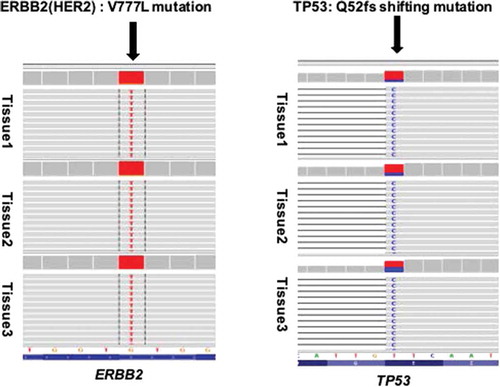 Figure 2. Resistance to trastuzumab and lapatinib induced by the HER2 V777L mutation. Representative image of read alignments visualized with IGV. HER2 V777L mutation and TP53 Q52fs shifting mutation were detected in the different tissues. The tissues 1/2/3 refer to the paraffined tissues of postoperative right breast lesion (July 2014), left lung metastasis and right chest wall recurrence lesions (September 2015). The arrow shows the position of the variant.