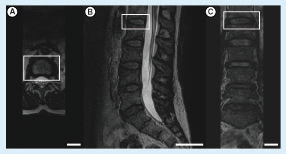 Figure 2. MRI images of the patient.Images taken from the (A) axial, (B) sagittal and (C) coronal planes. The L1–L2 intervertebral disc was indicated by the white rectangle (scale bars: 4 cm).