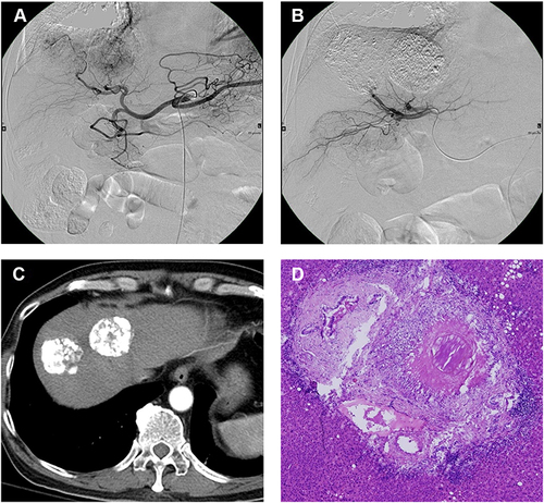 Figure 1 (A) 64-year-old male with two HCCs in S4 and S8 receiving combined ethanol-Lipiodol mixture and DEB-TACE. (A and B) The hepatic angiography before and after TACE procedure showed remarkable tumor reduction. (C and D) Follow up CT at 1 month showed dense Lipiodol deposition and complete response of the tumors. After successful downstaging, the patient underwent liver transplantation. The explant confirmed complete pathologic necrosis.