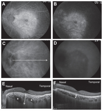 Figure 2 Fluorescein angiograms (A and B) and indocyanine green angiograms (C and D) in May 2008. The arrow points to the direction and length of the enhanced depth imaging optical coherence tomographic scan (EDI-OCT) (C). The EDI-OCT image shows large low-reflective areas (indicated by asterisks) in the outer choroid in the patient (E) which was not noted in a control subject (F).