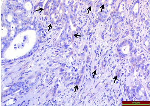 Figure 2 Light microscopic examination of TRPA1 immunoreactivity immunohistochemical staining in Low-Grade colon adenocarcinoma tissues. Arrows indicate areas of immunohistochemical staining.