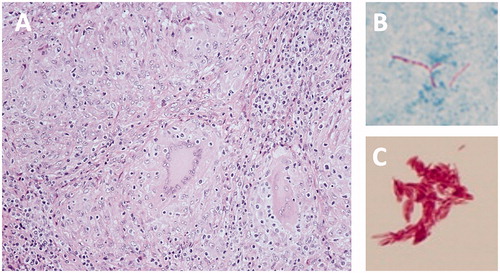 Figure 2. Histopathological and microbiological findings. (A) HE stain showing the granulomas due to numerous epithelial cells and multinucleated giant cells. (B) Chirnelsen stain showing anti-acid bacteria in large numbers. (C) Anti-acid bacteria stained after being cultured on blood agar.