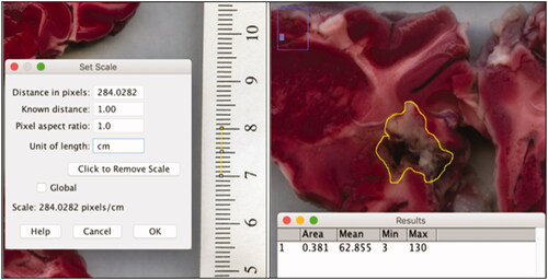 Figure 5. The ablation volume is calculated using ImageJ (NIH funded open access software). Left – a ruler adjacent to the coronal brain sections is used to calibrate the software between pixels and cm. Right – the area of ablation damage is outlined and the software calculates the circled area.