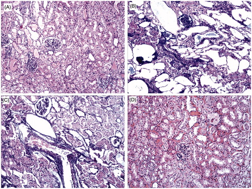 Figure 2. Pathological characteristics of kidney ablation areas (HE staining, 100x). (A) Normal kidney tissue. (B) Carbonization zone. (C) Coagulation zone. (D) Inflammatory reaction zone.