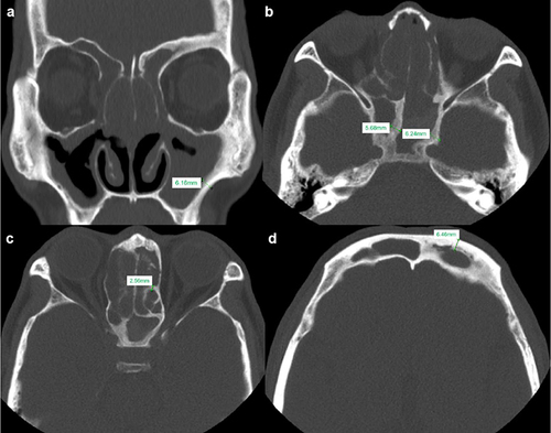 Figure 1 Radiological measurement using Global Osteitis score scale system for computed tomography of the paranasal sinuses. Measurement was made for hyperostosis area with maximal thickness of the osteitic focus in all the sinuses, for example (a) maxillary sinus (b) sphenoid sinus (c) ethmoidal sinus and (d) frontal sinus.