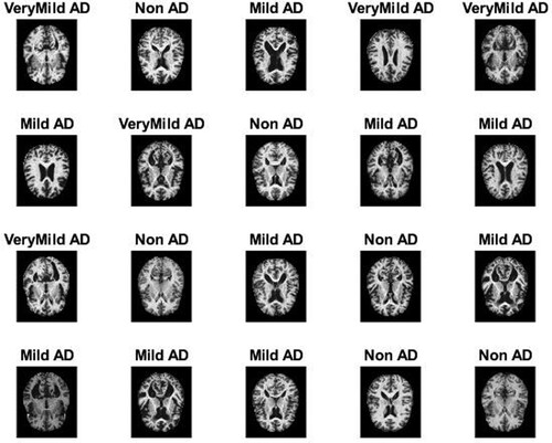 Figure 2. Set of MRI image samples for AD.