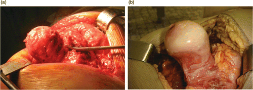 Figure 4. Difference in the presence of soft tissue lobes around the femoral head and neck of a live patient (a) and a cadaver (b). The cadaver has less soft tissue present.