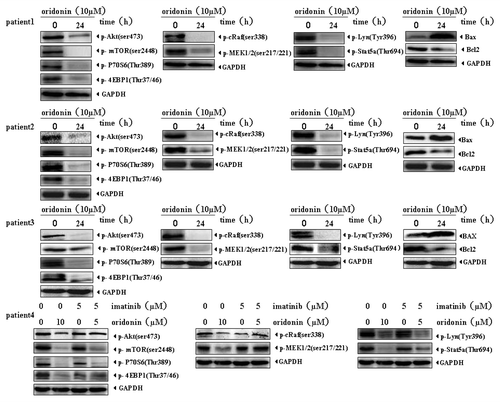 Figure 7. Oridonin downregulates signaling pathways in Ph+ ALL patient primary cells. The mononuclear cells from Ph+ ALL patients were treated with 5 μM oridonin,10 μM oridonin, 5 μM imatinib, or 5 μM oridonin with 5 μM imatinib for 24 h. Total proteins were extracted and equal amounts of protein from each sample were separated on SDS-PAGE and immunoblotted with indicated antibodies. GAPDH was used as a loading control. Oridonin significantly suppressed Akt/mTOR, Raf/MEK, STAT5 and LYN signaling pathways in all four clinical specimens. In patient 4 who progressed under imatinib therapy, 5 μM imatinib had little inhibitory effects on Akt/mTOR, Raf/MEK, STAT5 and LYN signaling while, 5 μM imatinib with 5 μM oridonin significantly inhibited the activation of mTOR, LYN and STAT5 signalings, but had no synergetic inhibitory effects on Raf/MEK.