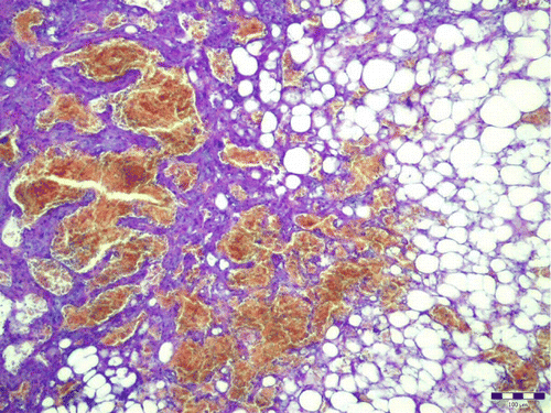 Figure 2. Smooth muscle bundles arranged in well-defined fascicles and around vascular channels. Haematoxylin and eosin. Bar: 100 µm.