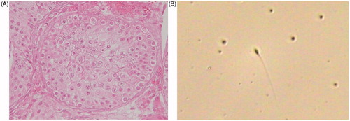 Figure 1. Spermatids in seminiferous tubules (A) and sperm in the ejaculate after rhFSH treatment (B). Patient of case 3 who could not obtain spermatozoa by microdissection testicular sperm extraction was confirmed to have arrested spermatogenesis at late stage of maturation arrest (A). Mature spermatozoa were found in the ejaculate after rhFSH administration (B). rhFSH: recombinant human follicle-stimulating hormone.