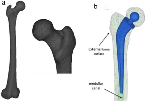 Figure 1. (a) Mesh of healthy femur (b) implant position.