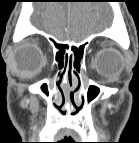 FIGURE 2  Coronal CT scan of the orbit demonstrating asymmetric thickening of right inferotemporal sclera.