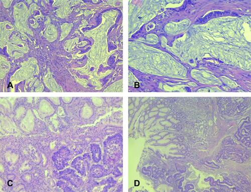 Figure 3 Histological features of mucinous colon adenocarcinoma and gastric carcinoma – intestinal type. (A and B) – mucinous colon adenocarcinoma. Strips of atypical tumor cells, and part of abortive glands floating in large extracellular mucin lakes comprising at least 50% of tumor area ((A) HEx200; (B) – HEx100). (C and D) – gastric cancer, intestinal type. Tumor is composed of confluent tubular structures consist of atypical cells with hyperchromatic nuclei similar to intestinal adenocarcinoma, which invade in submucosal gastric area. In upper part is antral mucosa with reactive mucinous foveolar hyperplasia ((C) - HEx100; (D) – HEx40).