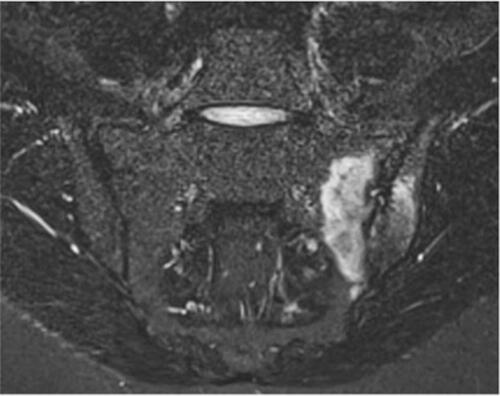 Figure 1 Sacroiliitis on MRI. Coronal STIR (short tau inversion recovery) sequence shows extensive subchondral oedema involving the left sacroiliac joint, consistent with unilateral sacroiliitis in a patient with psoriasis.