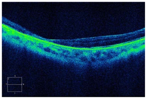 Figure 5 Optical coherence tomography image of the right eye 8 months after injury.