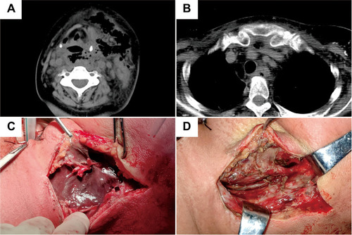 Figure 1 CT images of the neck showing low density shadowing and a gas shadow in the cervical subcutaneous, parapharyngeal, retropharyngeal, prevertebral, carotid, and upper mediastinum spaces (A and B). Necrotic fascia of the sternocleidomastoid muscle (C). Removal of necrotic tissue followed by flushing of the pus cavity (D).