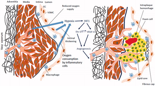 Figure 1. Hypoxia/ischaemia induces vasa vasorum neovascularization in atherosclerotic plaques. Intimal thickening, reduced oxygen supply and oxygen consumption due to the active metabolism of macrophages represent factors that lead to the induction of the intraplaque hypoxia (left panel). Indeed, hypoxia stimulates hypoxia-inducible factor 1 (HIF1) that directs transcription of proangiogenic factors such as vascular endothelial growth factor A (VEGF-A) and E26 transformation-specific-1 (Ets-1). Ets-1 is a transcription factor that activates VEGF expression. VEGF reciprocally stimulates Ets-1 activity. Indeed, induction of VEGF and Ets-1 activates angiogenesis and formation of neovessels. However, due to the deregulated angiogenic control, influence of proinflammatory plaque microenvironment and lipid core, neovessels have the immature phenotype associated with fragility, morphological defects, increased permeability and leakage. The leaky neovessels is the main cause of intraplaque haemorrhage. Intraplaque neovascularization is a strong indicator of future plaque destabilization and rupture.