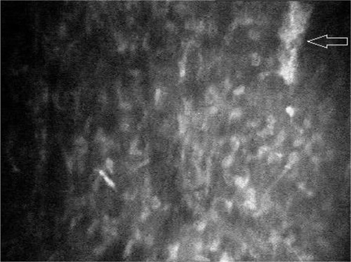 Figure 4 Cluster of cells (arrow) observed in anterior stroma of the right eye in stage 3 keratoconus. Magnification 500× with 40× objective lens.