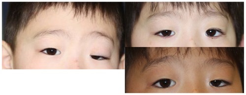 Figure 2 A 5-year-old boy with a congenital ptosis of the left eye.