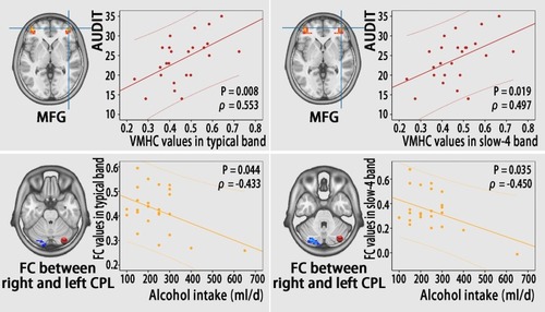 Figure 6 Correlations between functional results (VMHC and FC) and clinical variables (AUDIT score and alcohol intake) in individuals with AD.