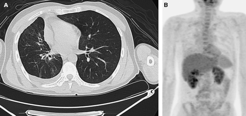 Figure 2.  (A) Chest CT after 8 cycles of combination treatment with cetuximab demonstrating a dramatic reduction of pericardial effusion, pleural effusion and primary lung mass.(B) FDG PET scan showing no evidence of active viable tumor.