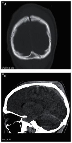 Figure 1 Head computed tomograms showing skull fractures (A) and scattered traumatic subarachnoid hemorrhages (B).
