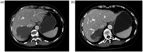 Figure 2. Pre-MWA (a) and one-year post-MWA and (b) CT examinations show a significant reduction in size of hemangioma after MWA treatment.